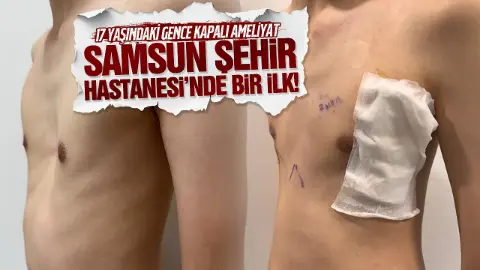 Samsun Şehir Hastanesinde ilk: 17 yaşındaki çocuğun’kunduracı göğsü’ kapalı ameliyatla düzeltildi