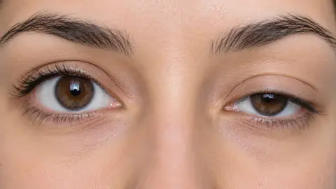 Göz kapağı düşüklüğü masum bir estetik sorun olmayabilir