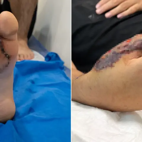 Dünyada çok nadir görülüyor: Elini kıyma makinesine kaptırmıştı! Baran'a ayaktan başparmak yapıldı