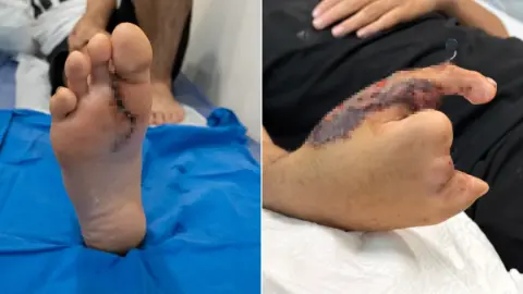 Dünyada çok nadir görülüyor: Elini kıyma makinesine kaptırmıştı! Baran'a ayaktan başparmak yapıldı