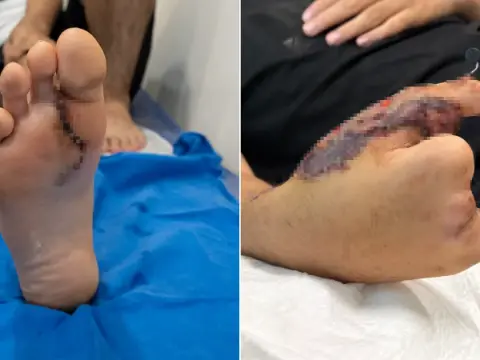Dünyada çok nadir görülüyor: Elini kıyma makinesine kaptırmıştı! Baran'a ayaktan başparmak yapıldı