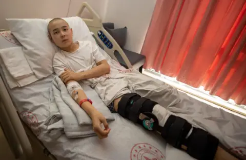 Kemik kanseri Kırgız 12 yaşındaki çocuk Türkiye'de bacağını kaybetmekten kurtuldu