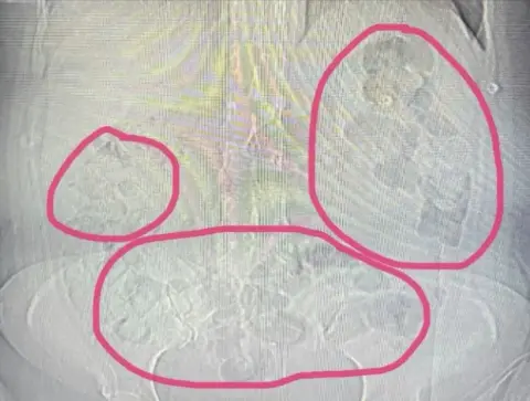 Midesinden uyuşturucu çıkan şahıs tutuklandı