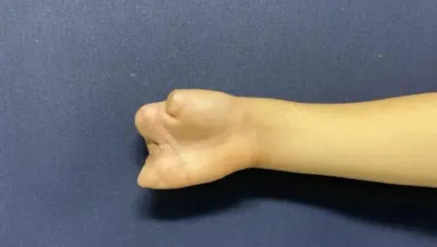 13 yaşındaki çırağın elini kıyma makinesi parçaladı ayağından parmağı nakledildi